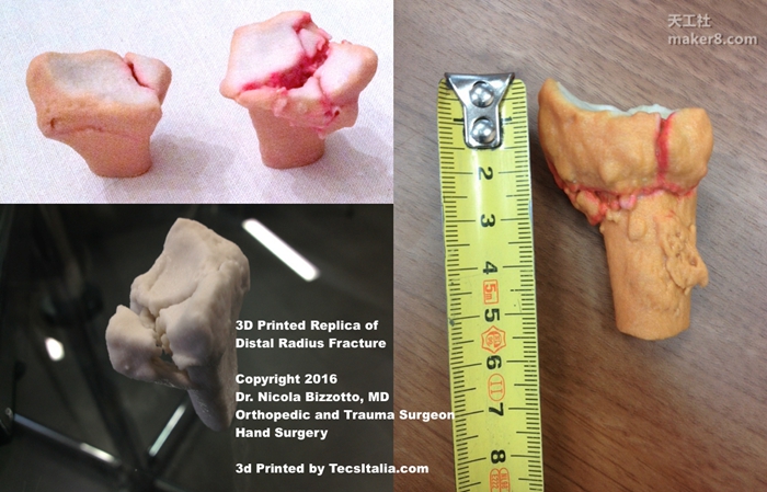 3D打印如何辅助医疗 3D打印手术应用的那些事儿

医疗3D打印,3D打印医疗,3D打印应用,3D打印领域,3D打印有哪些好处,3D打印的优势