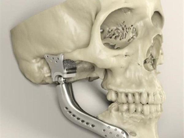 简述3D打印技术在医疗行业应用情况_e键3D打印服务
