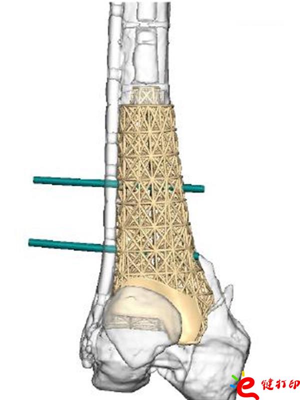 医疗3D打印,3d打印假肢,3d打印假肢,医疗3d打印模型,3D打印植入物,医疗3D打印平台