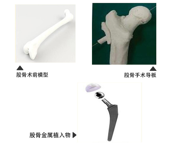 股骨金属植入物