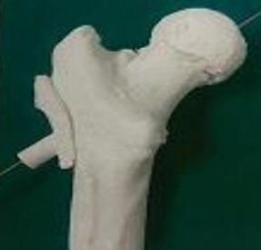 股骨金属植入物3