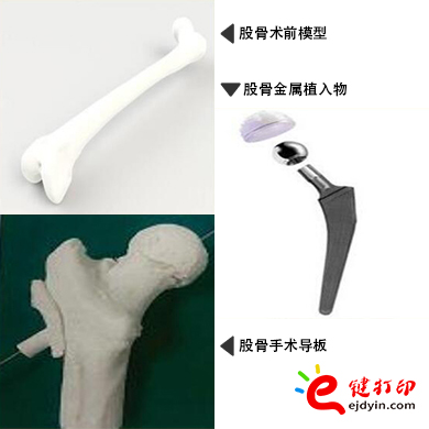 股骨金属植入物