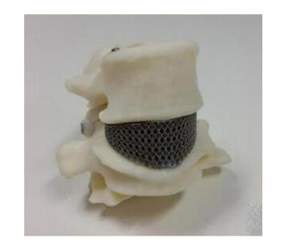 腰椎金属植入物