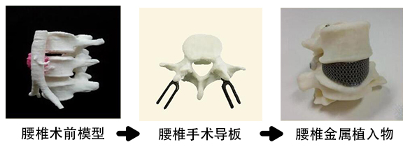 腰椎金属植入物2