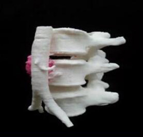 腰椎金属植入物3