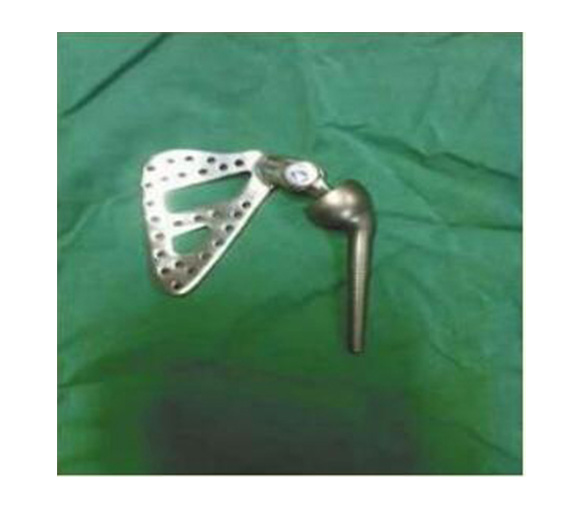 肩关节金属植入物