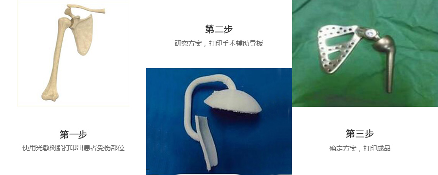 肩关节金属植入物制作流程