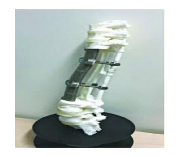 脊椎金属植入物