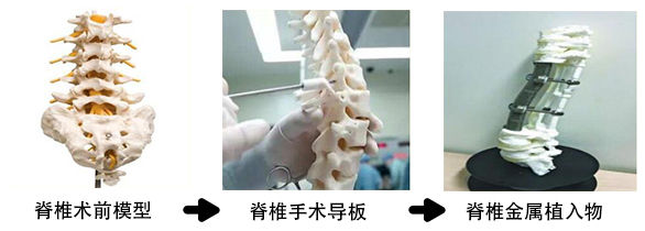 脊椎金属植入物2