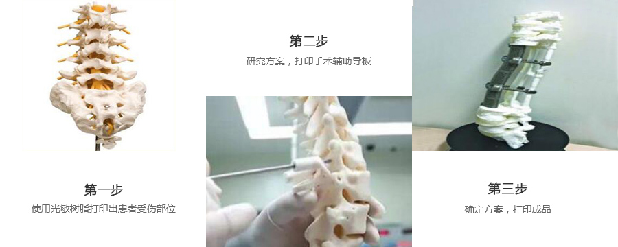 脊椎金属植入物制作流程